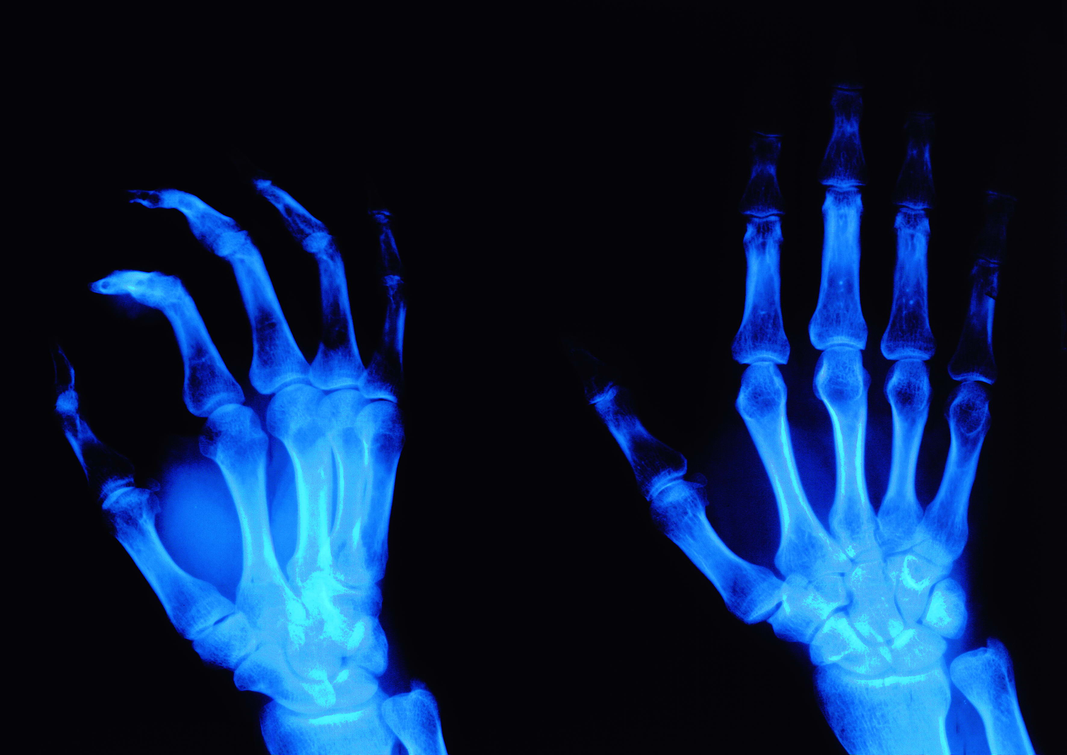 руки рентген, текстура, фон, скачать фото, arms x-ray texture background